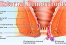 Complete Guide to Information External Hemorrhoids